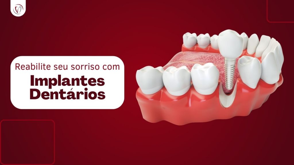Reabilite seus dentes com Implantes Dentários